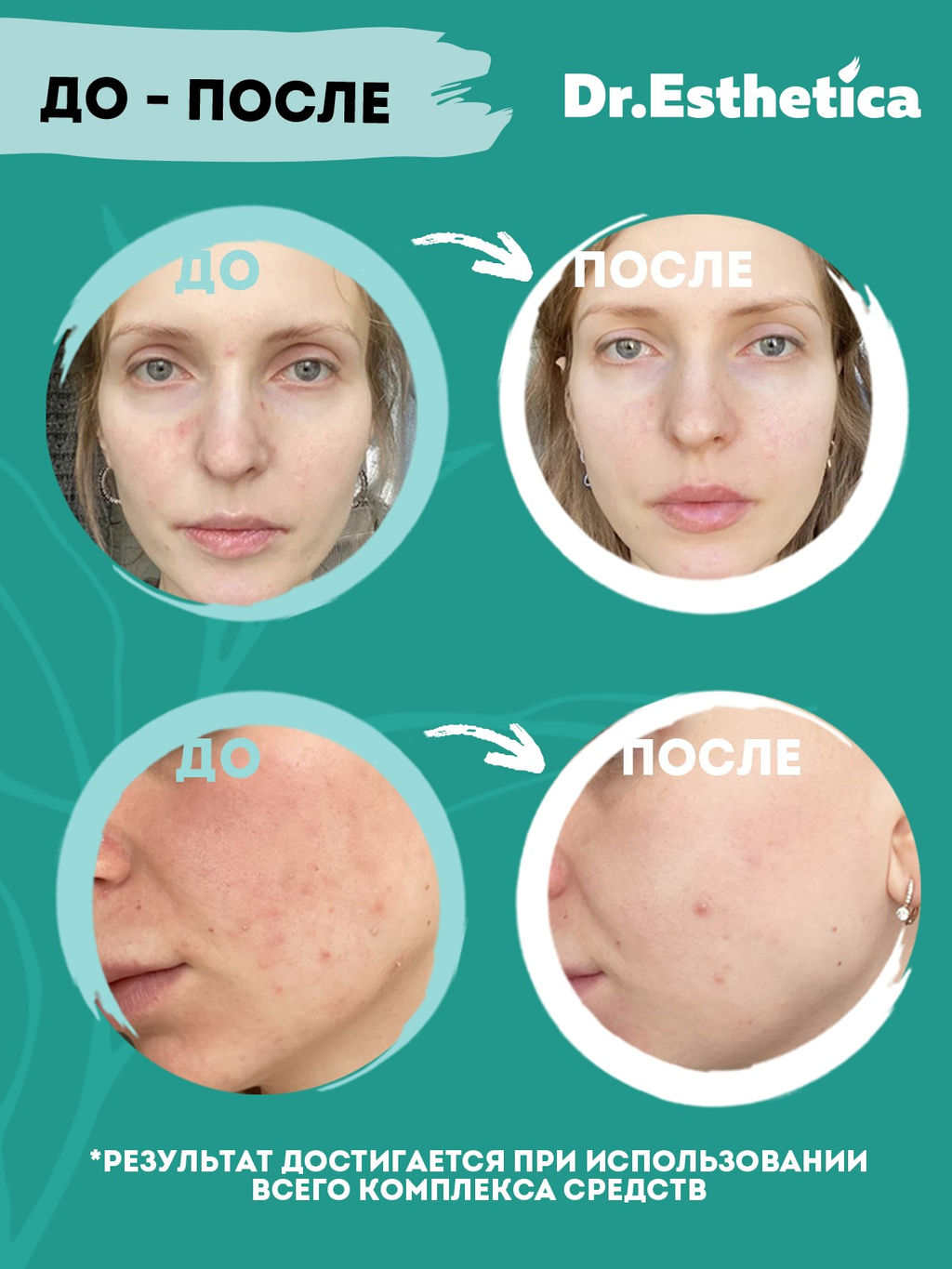DR. ESTHETICA NO ACNE ADULTS Двухэтапная очищающая грязевая маска, 3+10 г